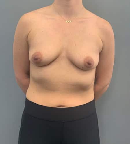 Before Image: Breast Augmentation - front