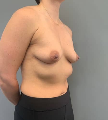 Before Image: Breast Augmentation - right-front-oblique