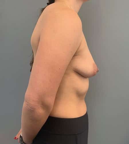 Before Image: Breast Augmentation - right-side