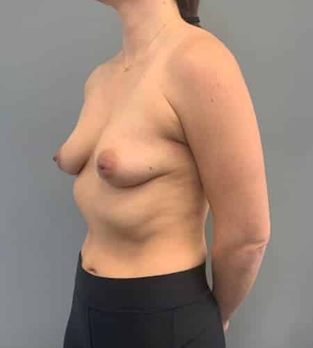 Before Image: Breast Augmentation - left-front-oblique