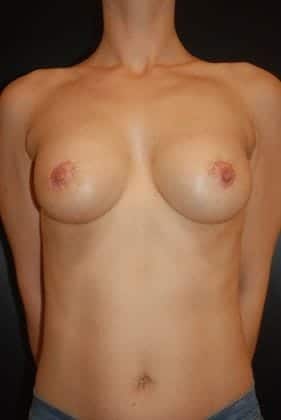 After Image: Breast Augmentation - front