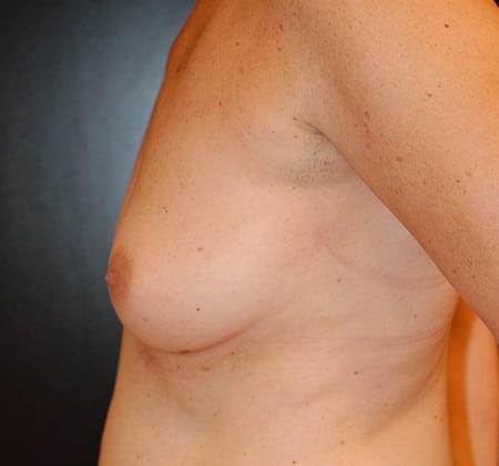 Before Image: Breast Augmentation - left-side
