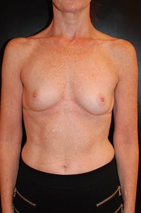 Before Image: Breast Augmentation - front