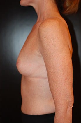 Before Image: Breast Augmentation - left-side
