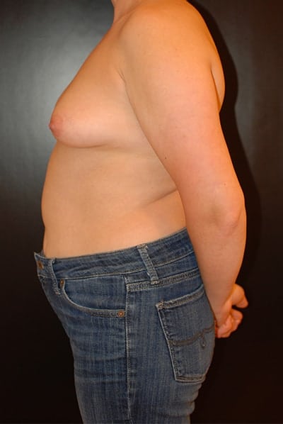 Before Image: Breast Augmentation - left-side