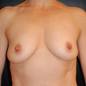 Before Image: Breast Augmentation - front