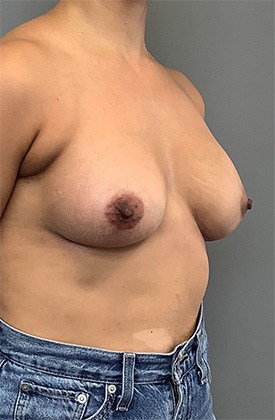 After Image: Breast Augmentation - right-front-oblique