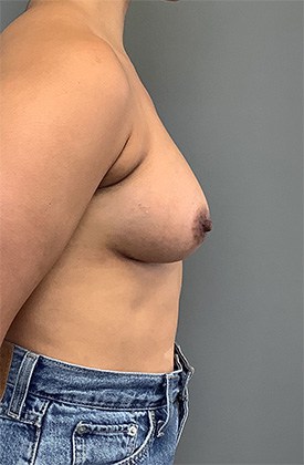 After Image: Breast Augmentation - right-side