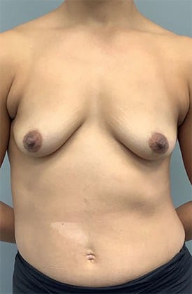 Before Image: Breast Augmentation - front