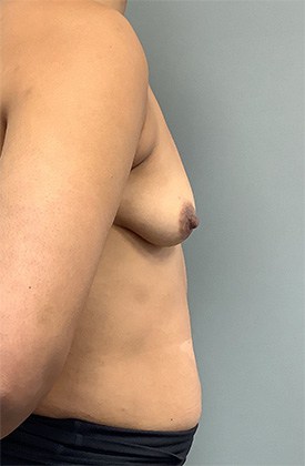 Before Image: Breast Augmentation - right-side