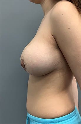 After Image: Breast Augmentation - left-side