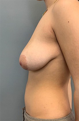 Before Image: Breast Augmentation - left-side