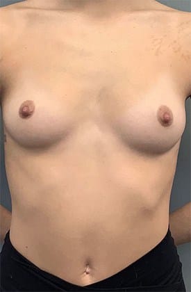 Before Image: Breast Augmentation - front