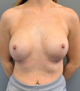 After Image: Breast Augmentation - front