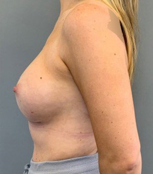 After Image: Breast Augmentation - left-side