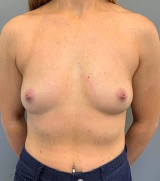 Before Image: Breast Augmentation - front