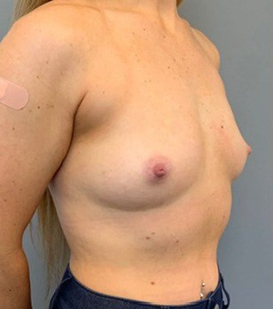 Before Image: Breast Augmentation - right-front-oblique