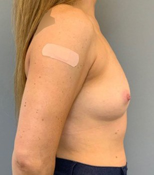 Before Image: Breast Augmentation - right-side