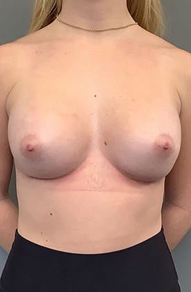 After Image: Breast Augmentation - front