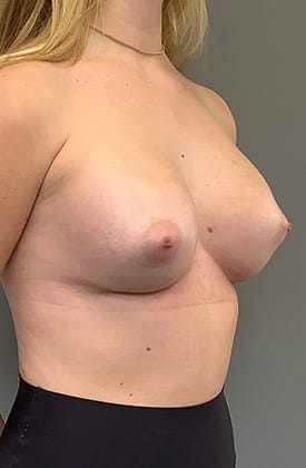 After Image: Breast Augmentation - right-front-oblique