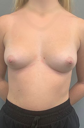 Before Image: Breast Augmentation - front