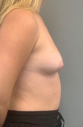Before Image: Breast Augmentation - right-side