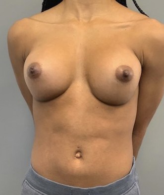 After Image: Breast Augmentation - front
