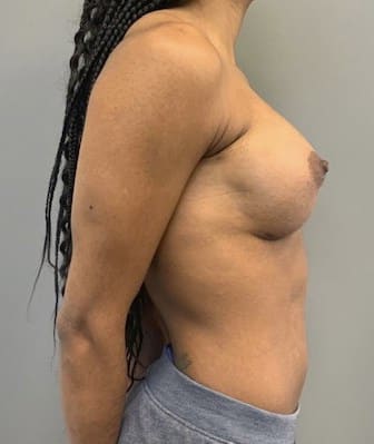 After Image: Breast Augmentation - right-side