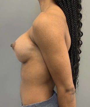 After Image: Breast Augmentation - left-side