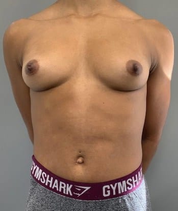 Before Image: Breast Augmentation - front