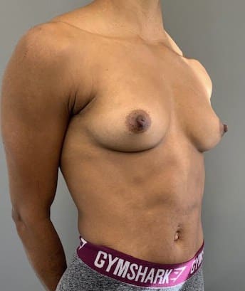 Before Image: Breast Augmentation - right-front-oblique
