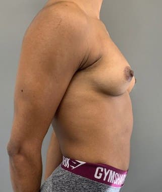 Before Image: Breast Augmentation - right-side