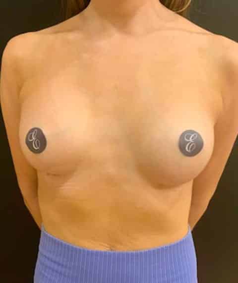 After Image: Breast Augmentation - front