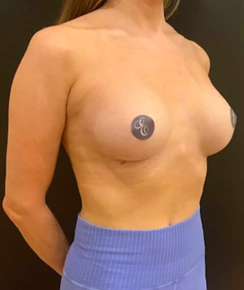 After Image: Breast Augmentation - right-front-oblique