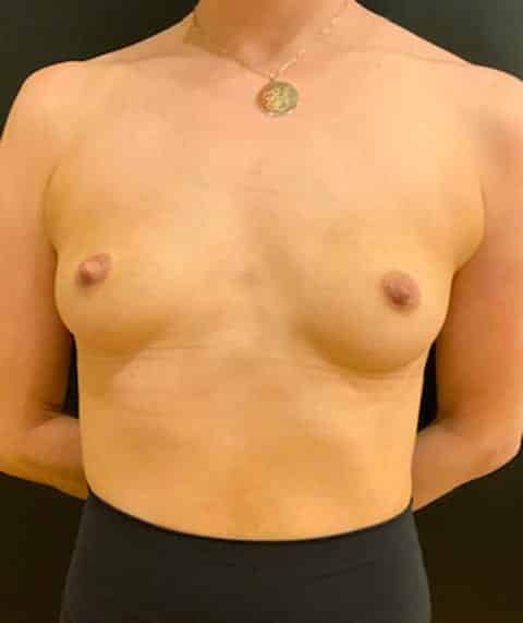 Before Image: Breast Augmentation - front