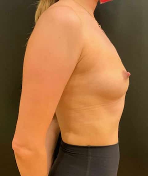 Before Image: Breast Augmentation - right-side