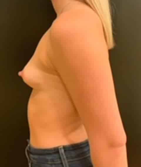 Before Image: Breast Augmentation - left-side