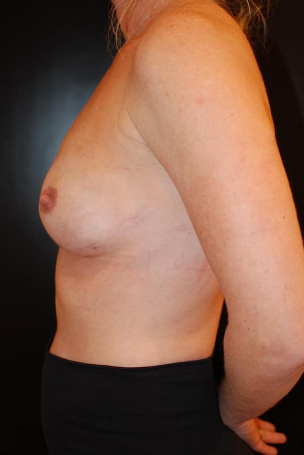 After Image: Breast Augmentation with Fat Grafting - left-side
