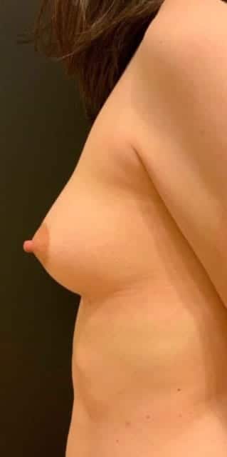 After Image: Breast Augmentation with Fat Grafting - left-side