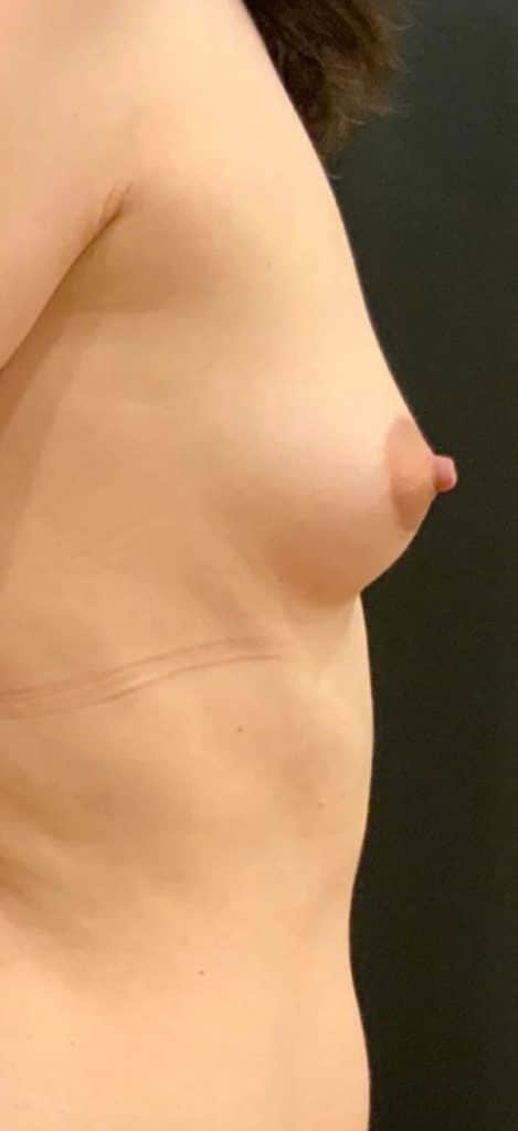 Before Image: Breast Augmentation with Fat Grafting - right-side