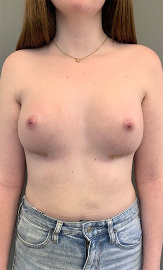 After Image: Breast Augmentation with Fat Grafting - front