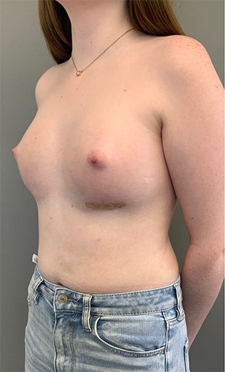 After Image: Breast Augmentation with Fat Grafting - left-front-oblique