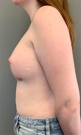 After Image: Breast Augmentation with Fat Grafting - left-side