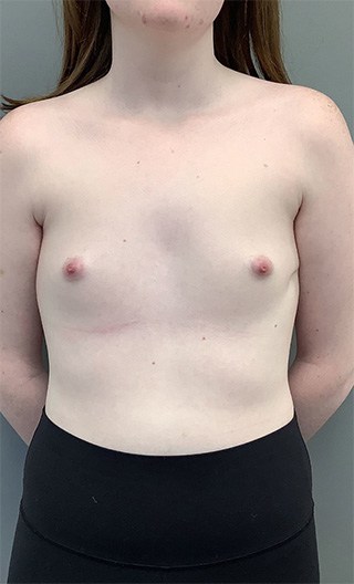 Before Image: Breast Augmentation with Fat Grafting - front