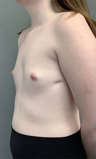 Before Image: Breast Augmentation with Fat Grafting - left-front-oblique