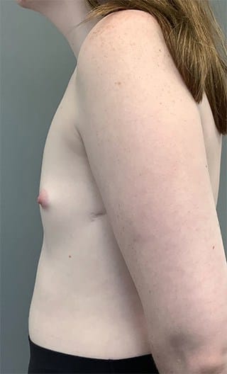 Before Image: Breast Augmentation with Fat Grafting - left-side