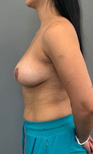 After Image: Breast Implant Removal - left-side