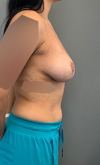 After Image: Breast Implant Removal - right-front-oblique