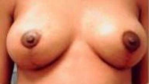 After Image: Breast Lift - front