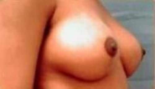 After Image: Breast Lift - right-front-oblique